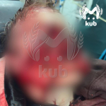 В Сочи две хаски напали и выгрызли часть лица ребенка